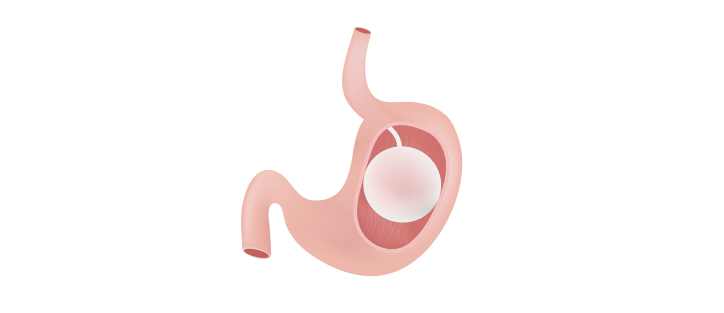Allurion Gastric Balloon