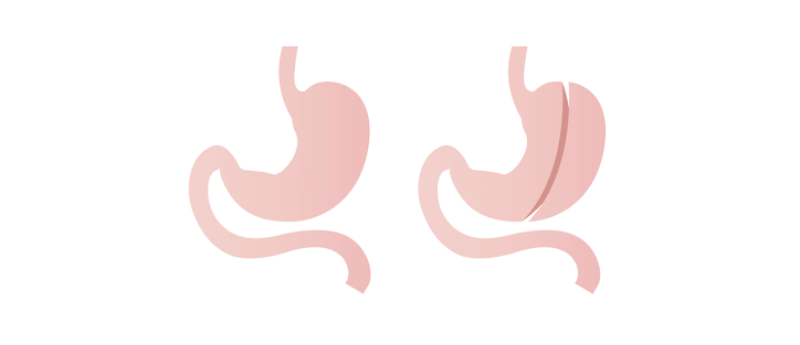 Gastric Sleeve