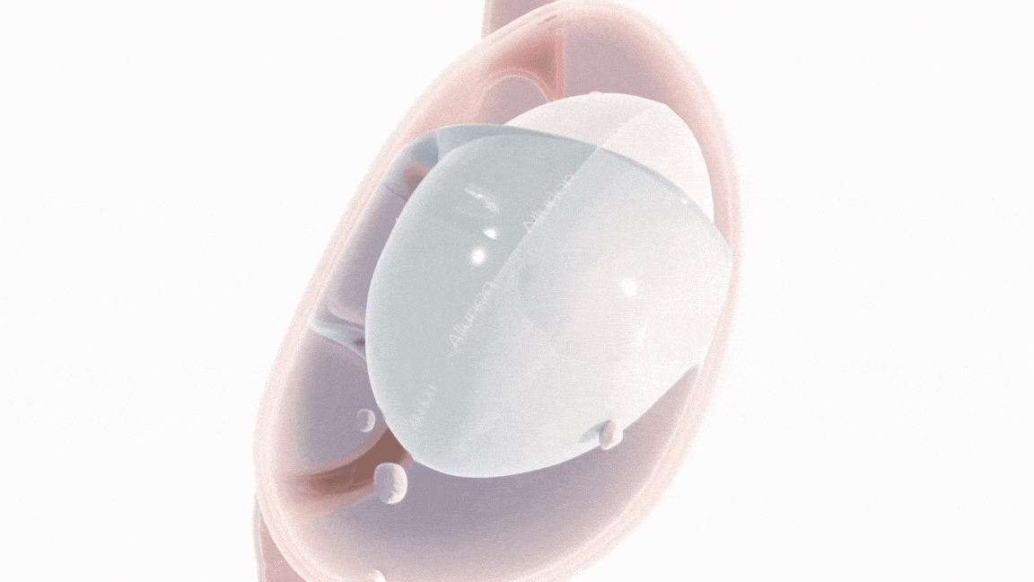 How Does the Gastric Balloon Work? | Allurion