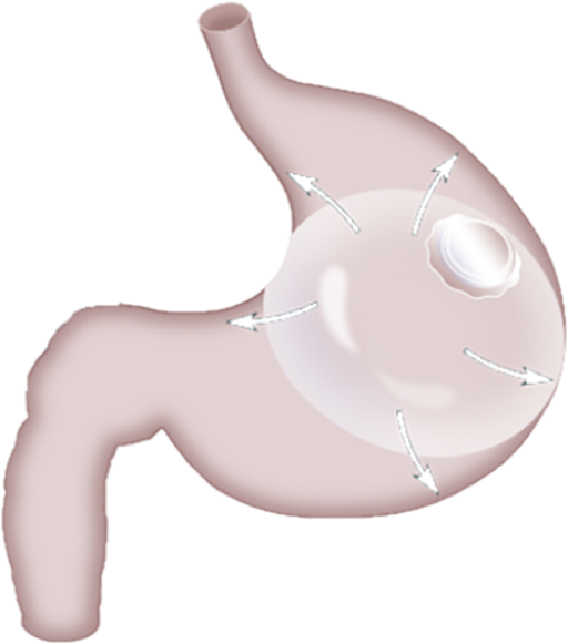 رسم يجسد بالون المعدة في المعدة