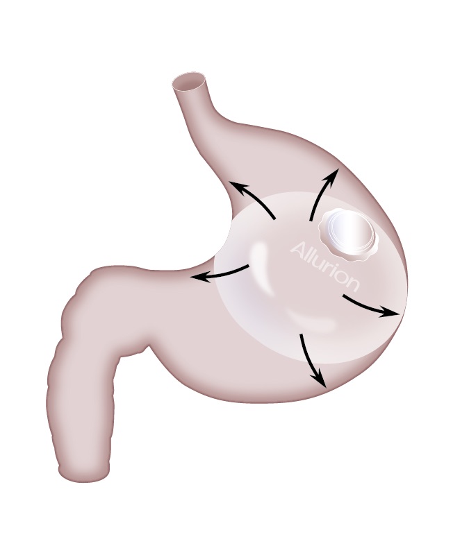 Allurion Balloon in the stomach