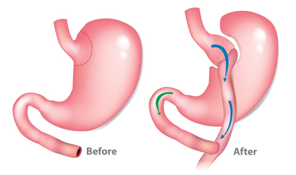 Gastric Bypass