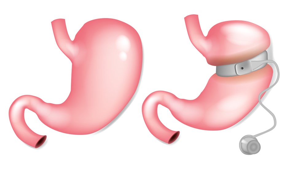 Gastric Band surgery