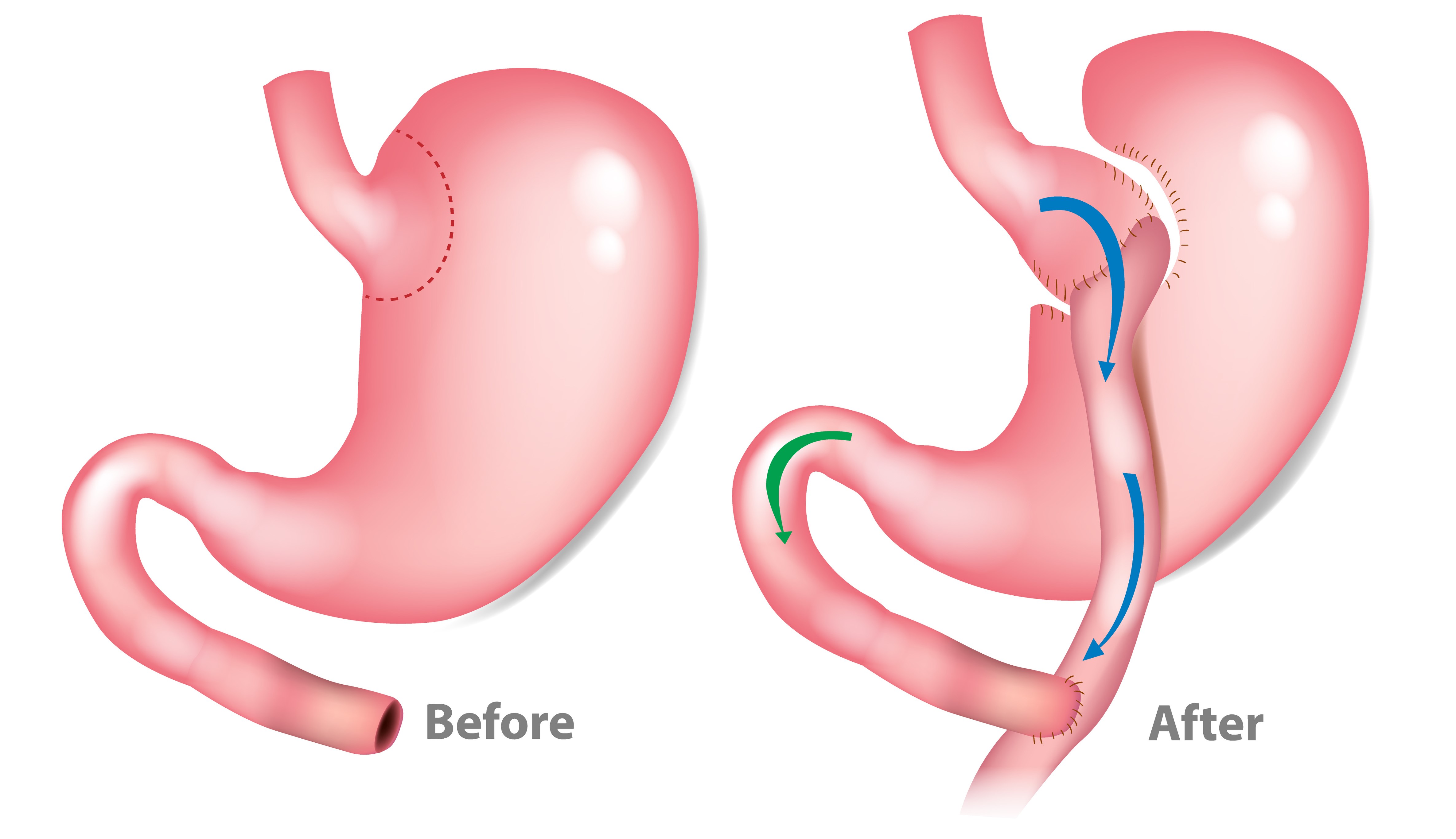 Gastric Bypass