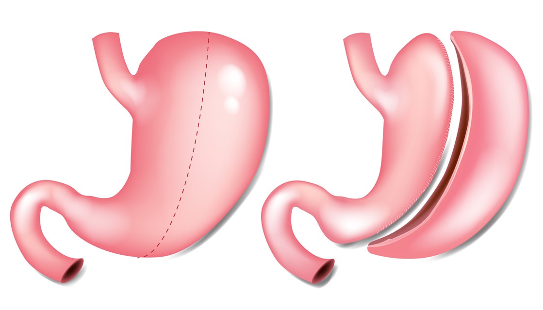 Gastric Sleeve