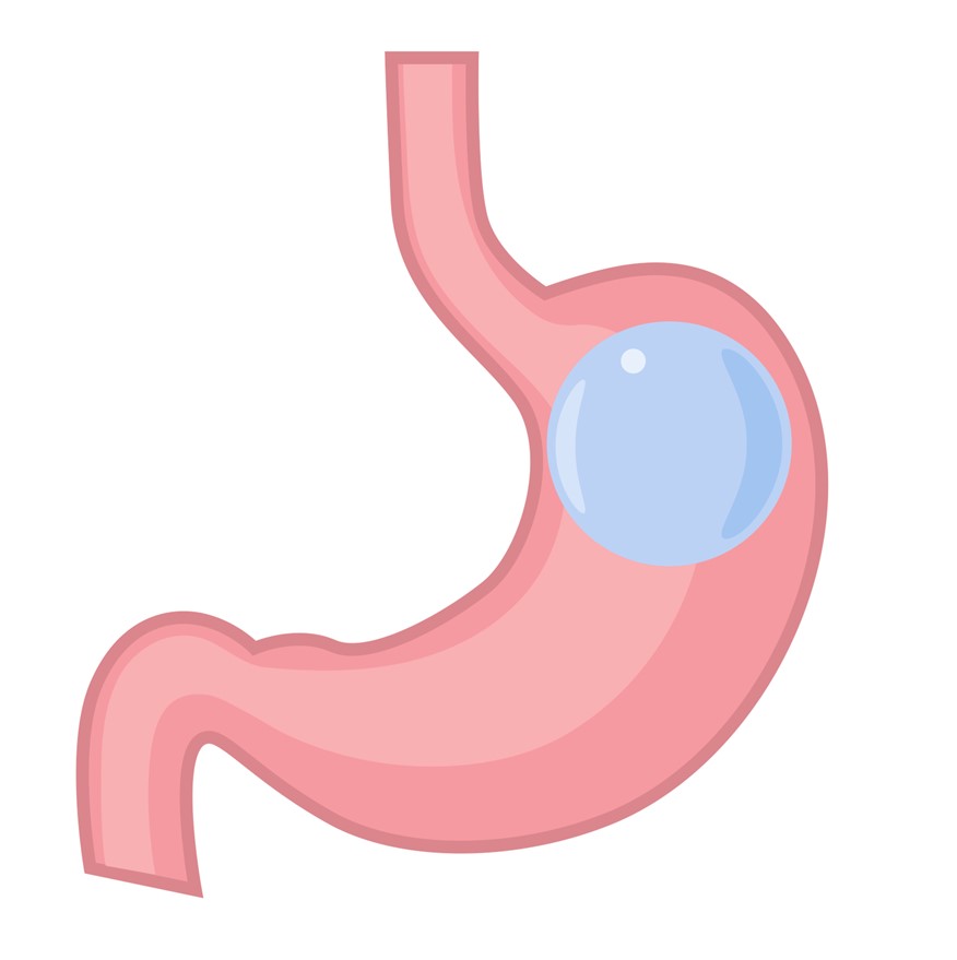 Gastric Balloon in the stomach