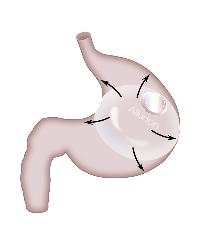 Allurion Gastric Balloon